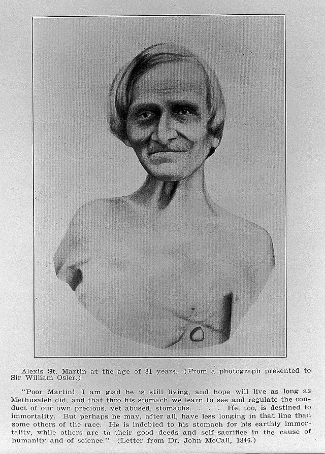 Alexis St. Martin